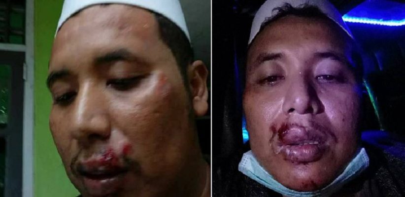 Bibir Bonyok, Ketua FPI Bogor Mengaku Digebuki Usai Ceramah di Jampang